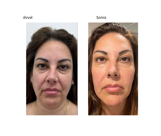 Classys Ultraformer MPT